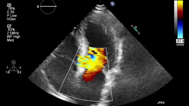 Ultrasound Transesophageal Examination Heart — Stock Video