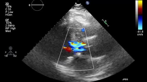 Exame Transesofágico Ultrassonográfico Coração — Vídeo de Stock