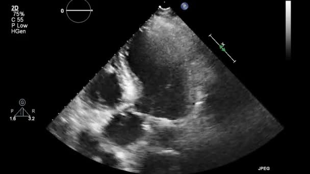 Ultraljudstransesofageal Undersökning Hjärtat — Stockvideo