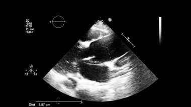Transesofageal ultrason sırasında kalbin gri ölçekli görüntüsü.