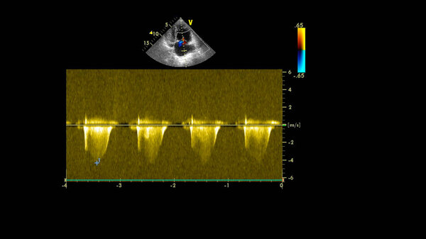 Изображение сердца во время трансофагеального ультразвука с доплеровским режимом.