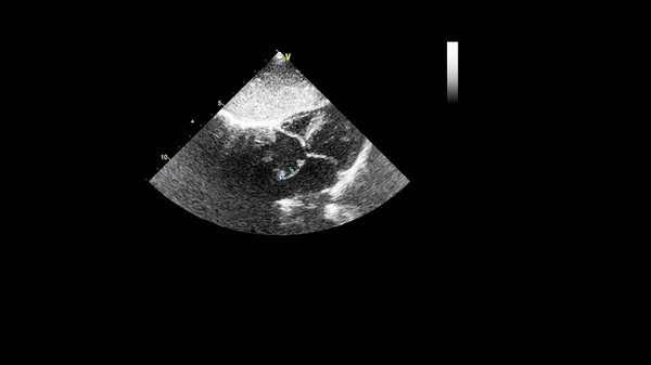 Imagem Coração Escala Cinza Durante Ultrassonografia Transesofágica — Fotografia de Stock