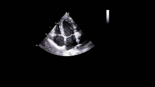 Afbeelding Van Het Hart Grijs Schaal Modus Tijdens Transesofageale Echografie — Stockfoto
