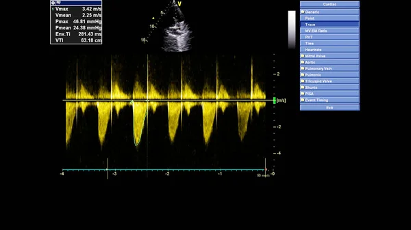 Transesofageal Ultrason Sırasında Kalbin Gri Ölçekli Görüntüsü — Stok fotoğraf