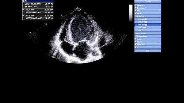 Kuva Sydämestä Harmaassa Mittakaavassa Transesofageaalisen Ultraäänen Aikana — kuvapankkivalokuva