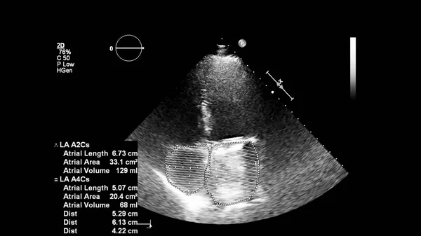 Kép Szív Szürke Skála Mód Során Transesophagealis Ultrahang — Stock Fotó