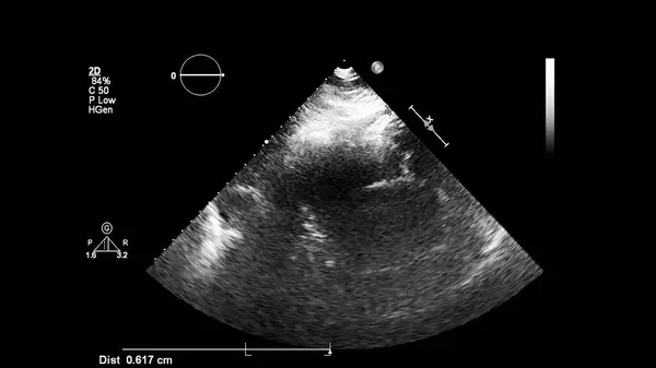 Transesofageal Ultrason Sırasında Kalbin Gri Ölçekli Görüntüsü — Stok fotoğraf