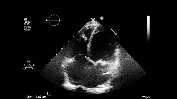 Image Heart Gray Scale Mode Transesophageal Ultrasound — Stock Photo, Image