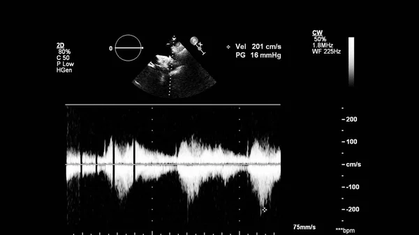 Kép Szív Szürke Skála Mód Során Transesophagealis Ultrahang — Stock Fotó