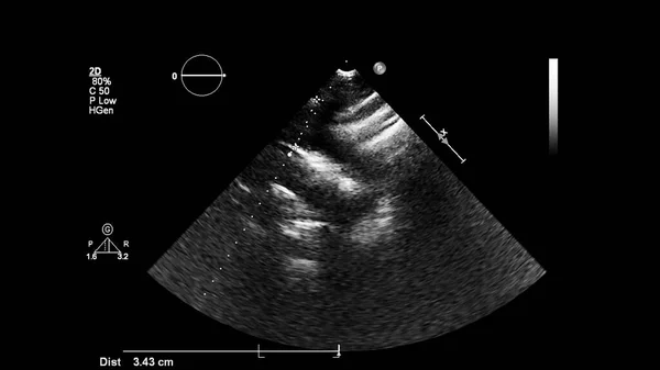 Abbildung Des Herzens Graustufen Modus Während Des Transesophagealen Ultraschalls — Stockfoto