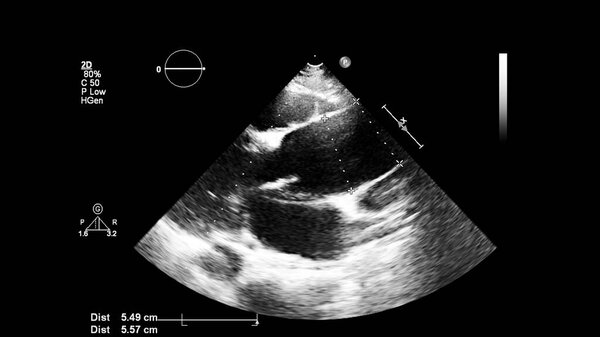 Image of the heart in gray-scale mode during transesophageal ultrasound.