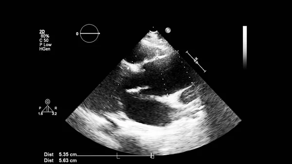 Afbeelding Van Het Hart Grijs Schaal Modus Tijdens Transesofageale Echografie — Stockfoto