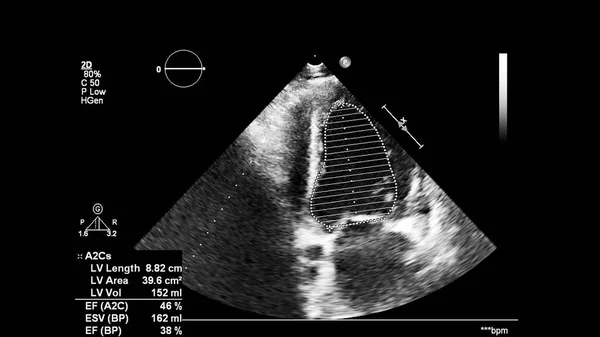 Image Heart Gray Scale Mode Transesophageal Ultrasound — Stock Photo, Image