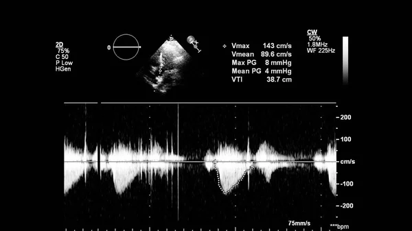 Imagem Coração Escala Cinza Durante Ultrassonografia Transesofágica — Fotografia de Stock