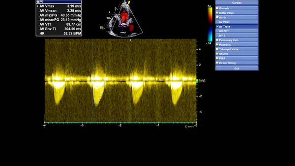 Transesofageal Ultrason Sırasında Doppler Kipi Ile Kalbin Görüntüsü — Stok fotoğraf