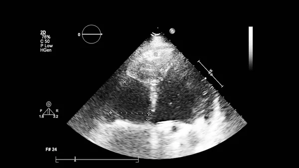 Immagine Del Cuore Scala Grigi Durante Ecografia Transesofagea — Foto Stock
