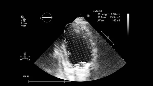Bild Hjärtat Gråskala Transesofagalt Ultraljud — Stockfoto