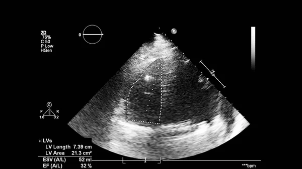 Зображення Серця Сіро Масштабному Режимі Під Час Ультразвукового Дослідження — стокове фото