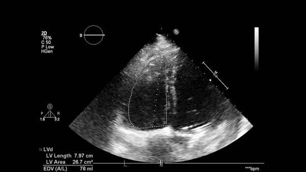 Afbeelding Van Het Hart Grijs Schaal Modus Tijdens Transesofageale Echografie — Stockfoto