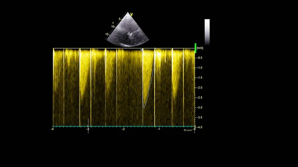 Abbildung Des Herzens Graustufen Modus Während Des Transesophagealen Ultraschalls — Stockfoto