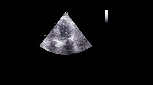 经食管超声下灰度型心脏影像学 — 图库照片