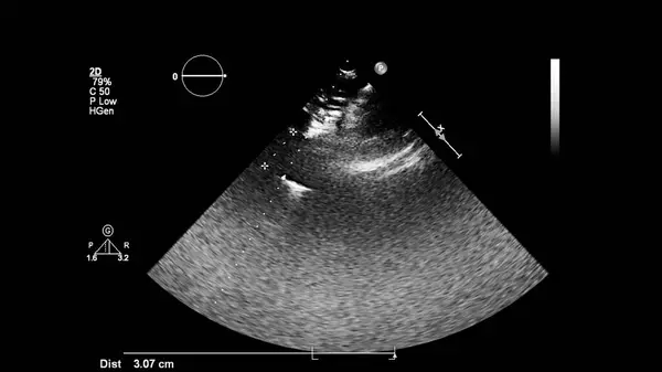 Imagem Coração Escala Cinza Durante Ultrassonografia Transesofágica — Fotografia de Stock