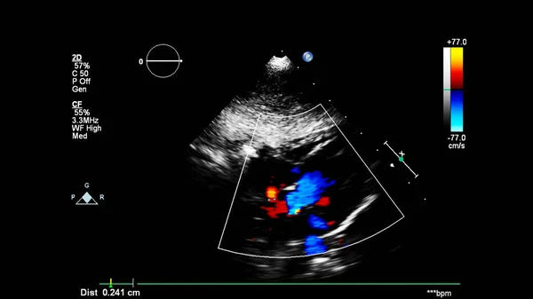 Imagem Coração Durante Ultrassom Transesofágico Com Modo Doppler — Fotografia de Stock