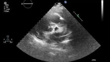 Kalbin ultrason transsofageal muayenesi.