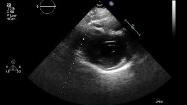 Kalbin ultrason transsofageal muayenesi.