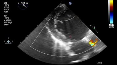 Kalbin ultrason transsofageal muayenesi.