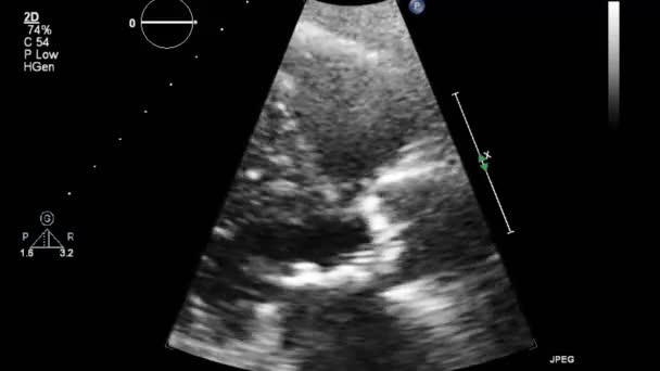 Ultraschall Transesophageale Untersuchung Des Herzens — Stockvideo