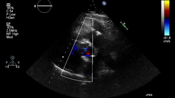 Ультразвукове Дослідження Серця — стокове відео