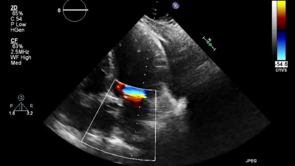 Ecografia Esame Transesofageo Del Cuore — Video Stock