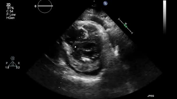 Exame Transesofágico Ultrassonográfico Coração — Vídeo de Stock