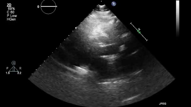 Exame Transesofágico Ultrassonográfico Coração — Vídeo de Stock