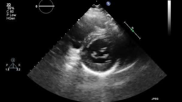 Kalbin Ultrason Transsofageal Muayenesi — Stok video