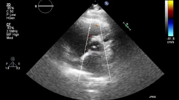 Kalbin Ultrason Transsofageal Muayenesi — Stok video