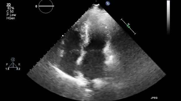 Ultraljudstransesofageal Undersökning Hjärtat — Stockvideo