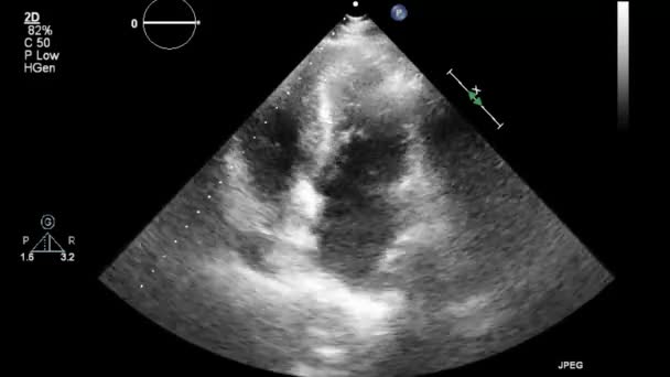 Ультразвуковое Трансофагеальное Исследование Сердца — стоковое видео