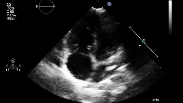 Echografie Transslokdarmonderzoek Van Het Hart — Stockvideo