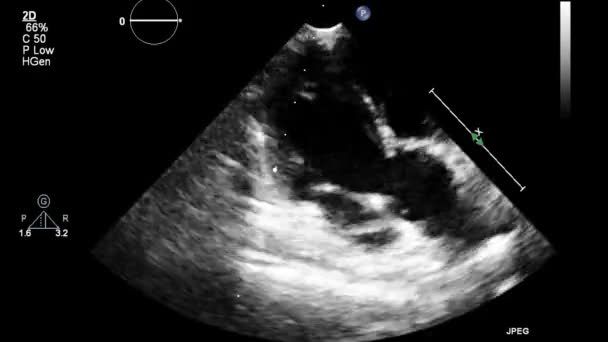 Ecografía Examen Transesofágico Del Corazón — Vídeo de stock