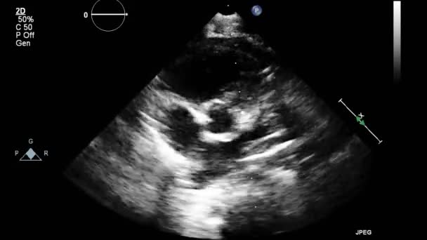 Ultrasound Transesophageal Examination Heart — Stock Video