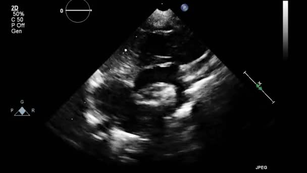 Examinarea Transesofagiană Ultrasunete Inimii — Videoclip de stoc