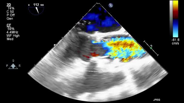 Ultraschall Transesophageale Untersuchung Des Herzens — Stockvideo