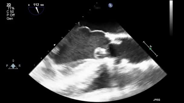 Szív Ultrahangos Transznyelőcső Vizsgálata — Stock videók
