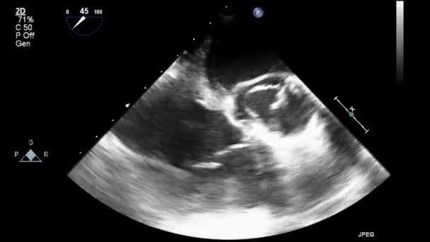 Echografie Transslokdarmonderzoek Van Het Hart — Stockvideo