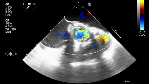 Kalbin Ultrason Transsofageal Muayenesi — Stok video