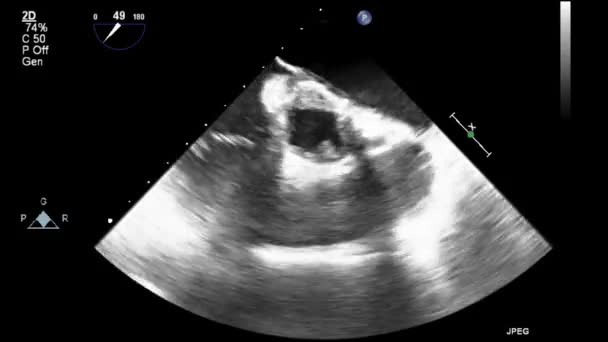 Echografie Transslokdarmonderzoek Van Het Hart — Stockvideo