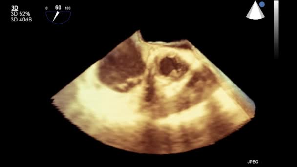 Ultraljudstransesofageal Undersökning Hjärtat — Stockvideo