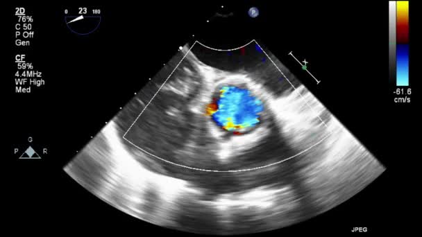 Ecografia Esame Transesofageo Del Cuore — Video Stock